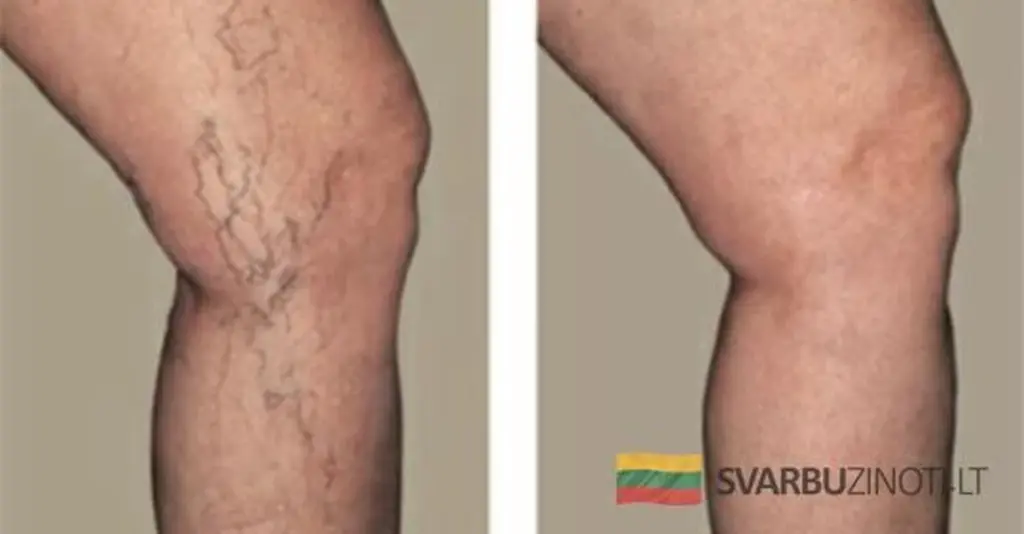 5 sencillos hábitos para prevenir las venas varicosas