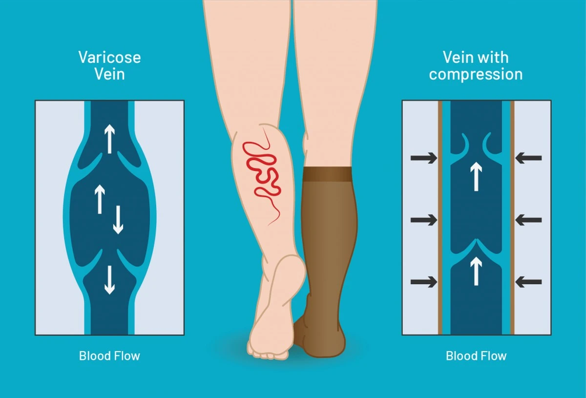5 sencillos hábitos para prevenir las venas varicosas - image 1