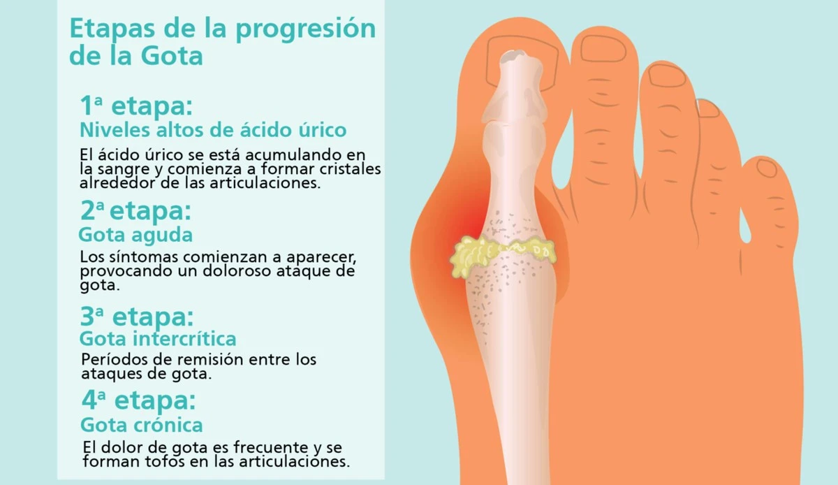 Adiós a la Uricidad en las Articulaciones: La Bebida Reveladora que Evita la Gota y Tumores - image 1