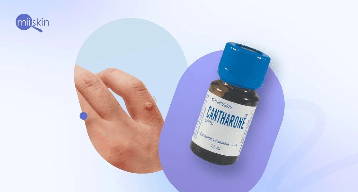 El dermatologo me reveló por qué | mi verruga volvía después del tratamiento y qué olvidaba hacer - image 1