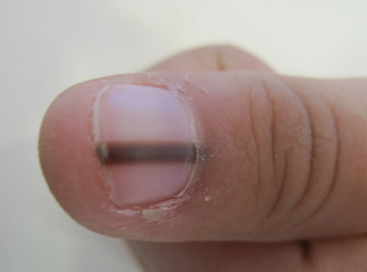 El secreto de chefs: cómo eliminar manchas de cúrcuma y remolacha de tus uñas - image 1