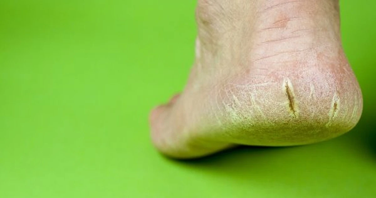 adiós a los talones agrietados con un ingrediente de cocina - image 1