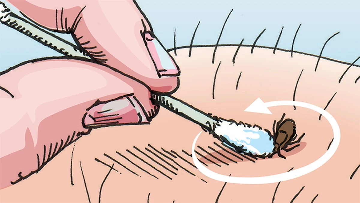 Cómo extraer una garrapata con un bastoncillo de algodón: el método fácil y efectivo - image 1