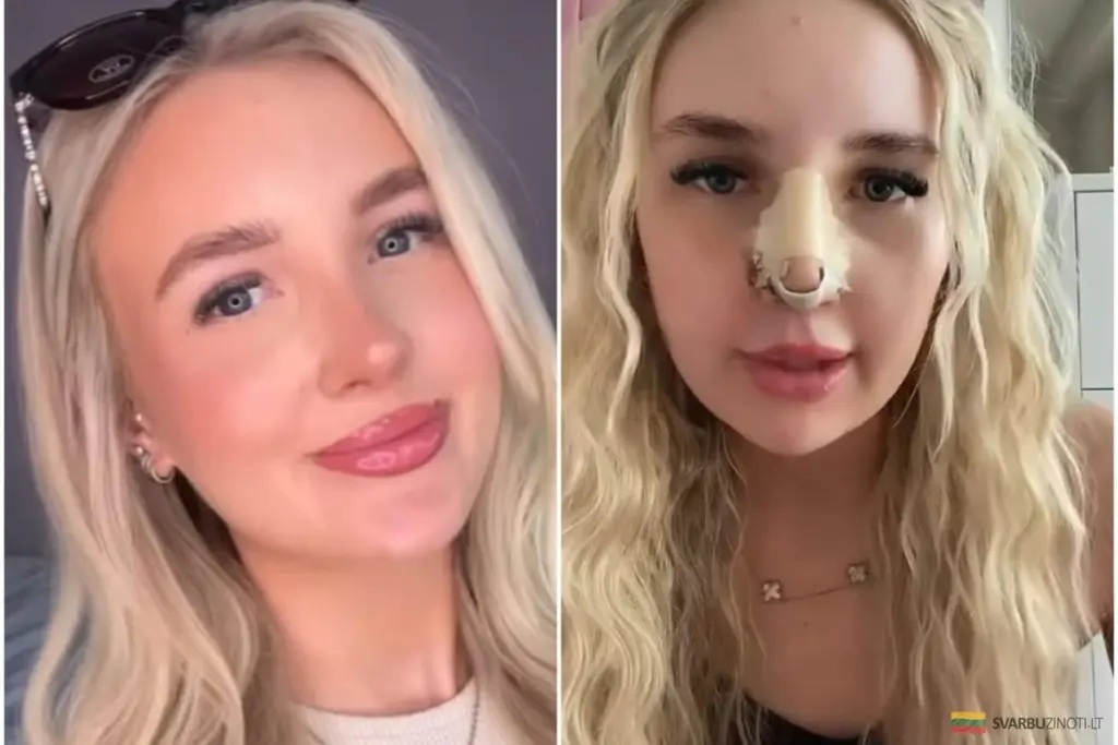 Perforación de 1 cm en la nariz: El peligro oculto del spray descongestionante