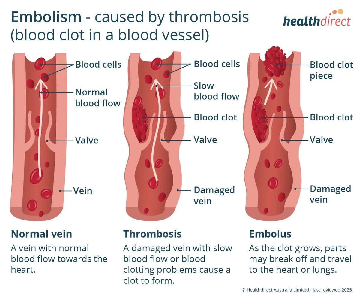 Un entrenador personal rozó la muerte por coágulos en los pulmones: 